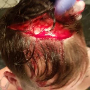 Amateur fighter Hunter Boone suffers gruesome injury at Martial Combat League 3